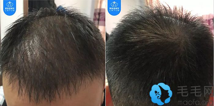杨志祥教授植发5个月头顶及后枕部位变得自然浓密