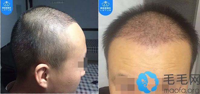 种植头发半个月及植发脱落期的照片