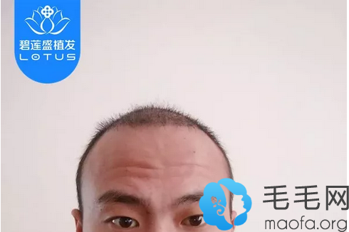 北京碧莲盛植发一个月效果图