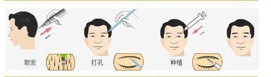 眉毛种植手术过程