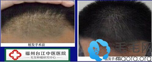 福州台江中医院毛发种植中心男性头发加密案例前后效果