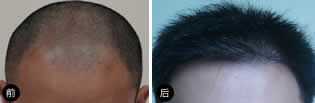 美基元医院为三级脱发的赵先生成功种植头发