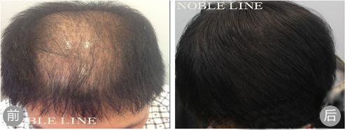 韩国Noble Line植发治疗头项严重脱发案例
