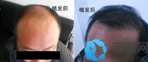 太原长城医学植发案例 男性严重脱发植发手术前后效果对比
