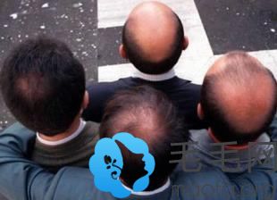 研究表明男性植发更有魅力秃头更具领导力