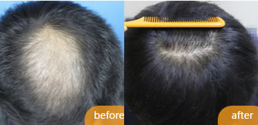 北京毛博士对男性患者实施头发加密植发手术