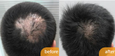 北京毛博士植发案例 男性疤痕种植头发效果
