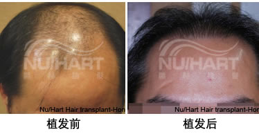 香港显赫植发案例 植发手术治疗严重脱发导致的秃顶