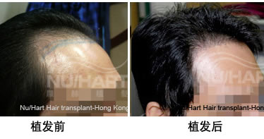 香港显赫为男性前额光秃实施植发手术