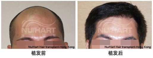 男性秃顶选择在香港显赫植发中心进行植发手术