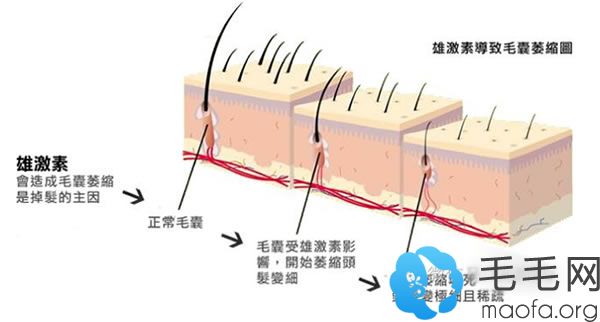 毛囊退化图片