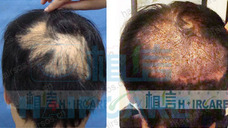 北京植信植发中心 疤痕修复植发案例
