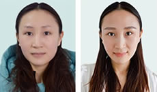 23岁美佳娜员工王女士选择植眉手术半年效果 素颜女神诞生