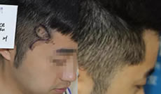 福州雍禾疤痕植发真实案例及五个月恢复效果图片