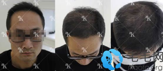 北京科发源头发移植八个月效果