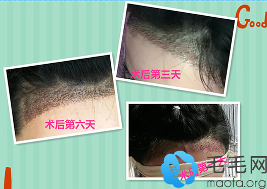 南宁贞韩植发做发际线种植术后第1~6天恢复过程图