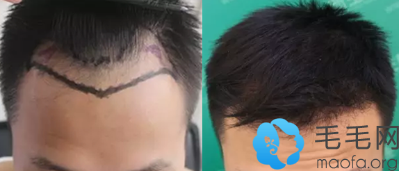 M型脱发男士在武汉新生植发做发际线种植案例前后效果对比图