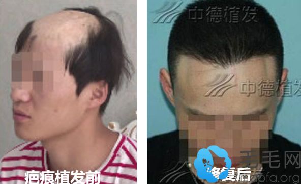 北京中德疤痕植发一年后效果对比图
