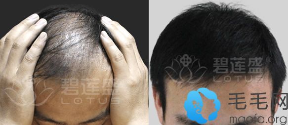 采用BHT植发技术做头发种植案例