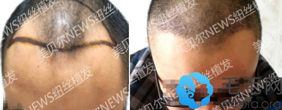 脂溢性脱发男性在贵阳美贝尔做头发种植案例