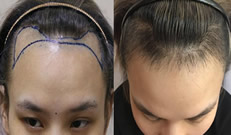 从植发际线37天恢复过程照片来看广州韩妃赵进植发效果好吗
