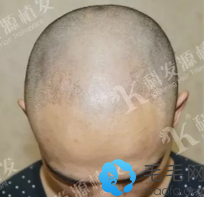 在深圳科发源做头发种植术前理发后