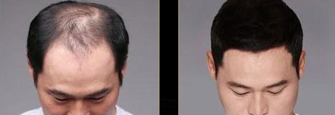 西宁韩美M型脱发种植与头顶加密种植实例