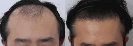 选择华美的胡译元给做植发,是在考察了海南植发半年后