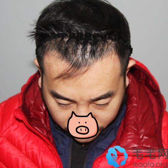 北京中德毛发移植医生徐霞为男化妆师种植发际线效果展示