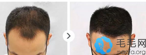 M型发际线的男生在广州雅度植发9个月的效果怎么样